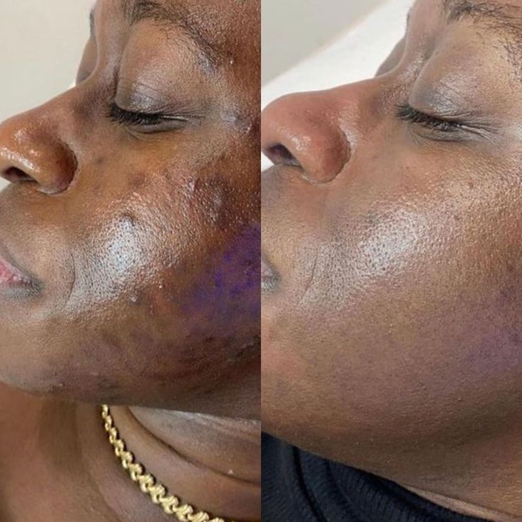 Peel Shot| Élimine les Impuretés et Sublime Votre Peau