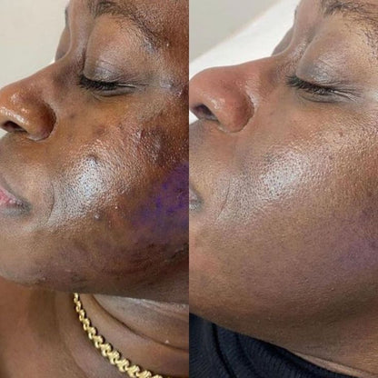 Peel Shot| Élimine les Impuretés et Sublime Votre Peau