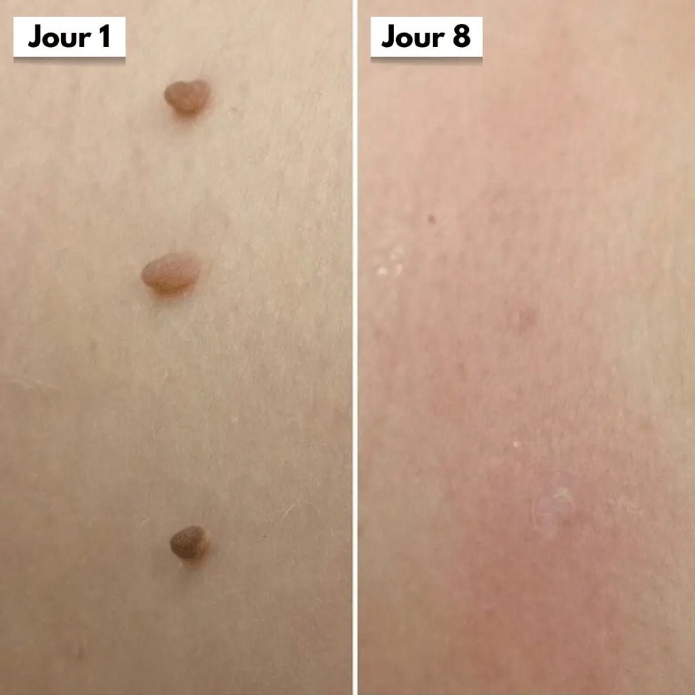 Éliminez ces excroissances en quelques jours, sans douleur